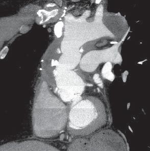 64-MDCT and tri-phasic IV contrast