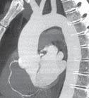 SUNDAY Prospective and Retrospective ECG Gating for Thoracic CT
