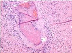 Rhabdoid/epithelioid GB Glandular/adenoid GB, epithelial and/or mesenchymal metaplasia Gliosarcoma RADIOLOGIC