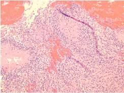 lymphoma, toxoplasmosis Heterogeneously enhancing mass: High grade neoplasm vs.