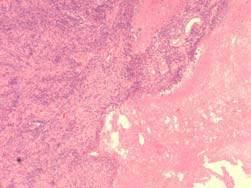 -Giant cells -Mitoses, necrosis, vascular proliferation GFAP