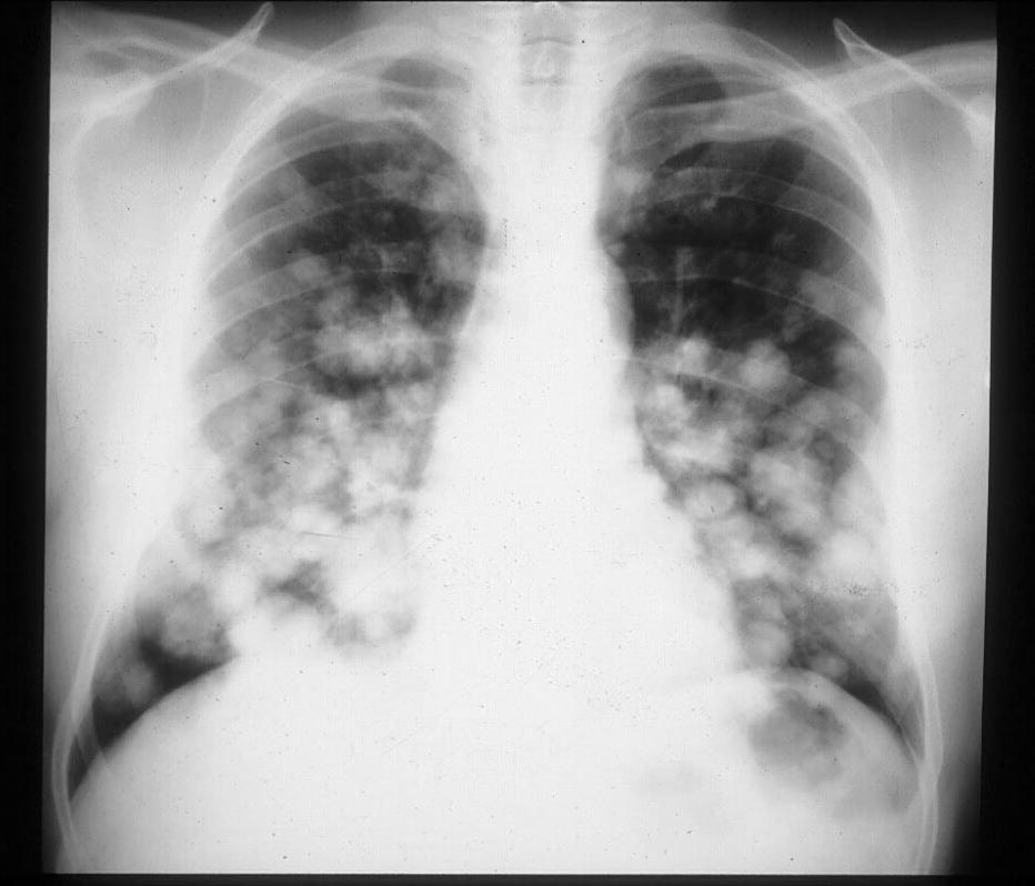 X-ray differential Miliary densities: TB/Fungal/Pneumoconiosis/ Certain malignancies such as