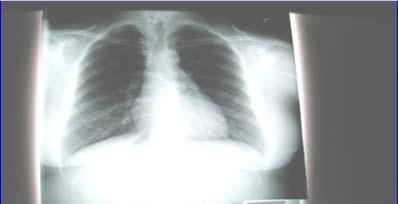 Basics of CXR Reading PA & lateral is ONE UNIT Normal vs.