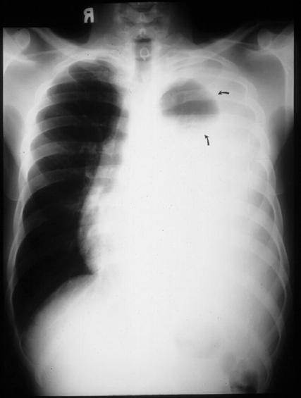 Item A 34-year woman with long- standing is admitted with progressive shortness of breath.