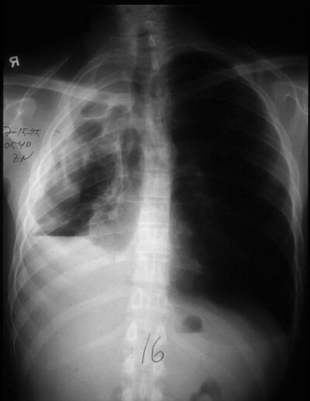 Answer X-ray features of pleural effusion Opacity without