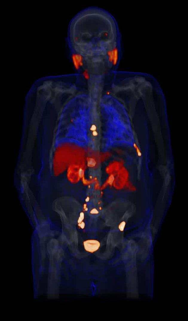 PyL: PET/CT IMAGING AGENT In-licensed from Johns Hopkins University PSMA Targeting Enables visualization of both bone and soft tissue metastases Highly specific to prostate cancer cells, not