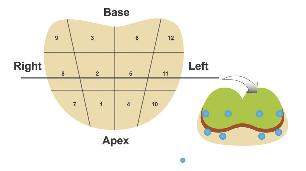 Woo et al. Base Right Left Apex : ROIs for SWE measurement A B C Fig. 1. Distribution of 12 sectors for systematic 12-core biopsy and acquisition of shear wave elastographic (SWE) parameters. A. Twelve systematic cores consisting of paramedian (1 6) and lateral (7 12) cores from base, mid-level and apex at each side of prostate gland.
