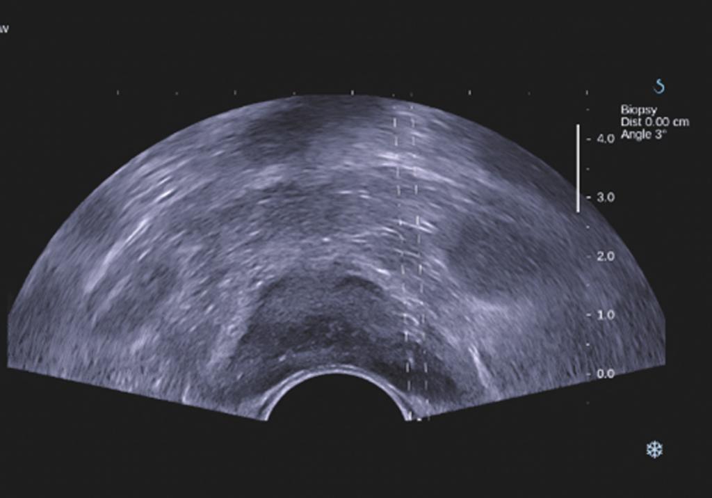 After acquisition of shear wave elastographic images, region of interest was placed at and around focal lesion with hypoechogenicity compared with surrounding prostate gland.