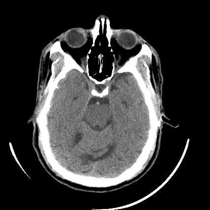 Case 5 CT Brain in the ED: Negative A 30 year-old man with no PMH presents with 6 hours of stupor. He is on no medications. General physical exam is normal.