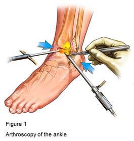 Common disorders in which ankle arthroscopy is useful Ankle arthritis Footballer s ankle (Anterior Ankle impingement)