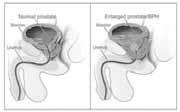 Symptoms of Enlarged Prostate: Irritative Overview of DHT in the Development of EP The development and growth of the prostate gland depends on androgen stimulation.