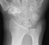 Acute pseudogout: diagnosis Crystal identification is the gold standard Radiographic chondrocalcinosis Common at the knee, wrist, symphysis