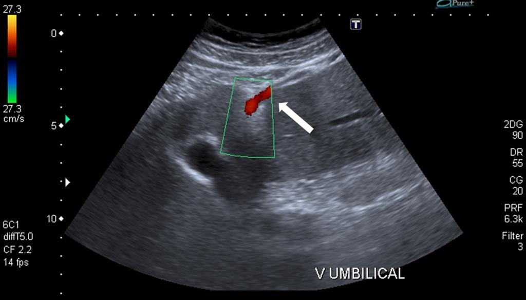 Fig. 5: Recanalized umbilical vein in portal hypertension: longitudinal color Doppler sonogram demonstrates that flow in this