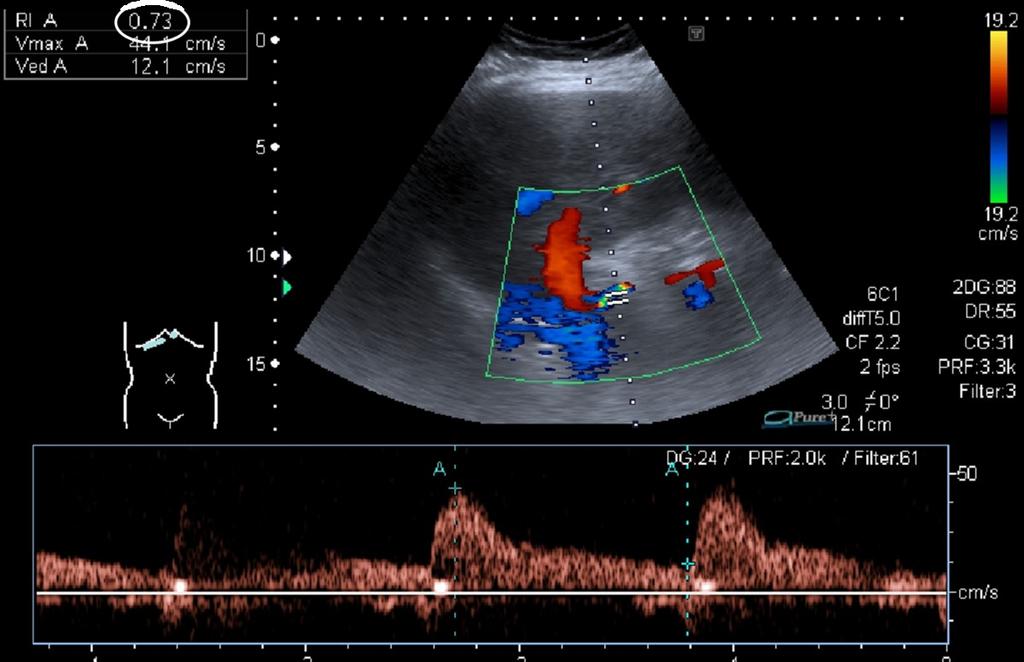 Fig. 9: Normal waveform and RI of hepatic artery in a patient with