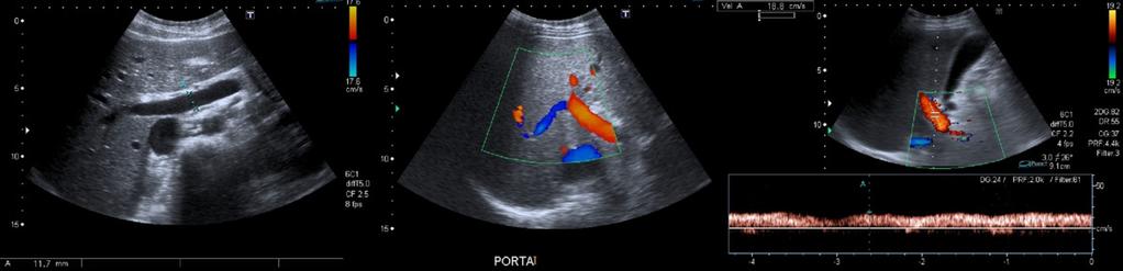 The waveform is obtained from a small sample volume that is placed in the center of the vessel (ideally, in the midportion of the lumen for optimal estimation of laminar flow) by the sonographer.