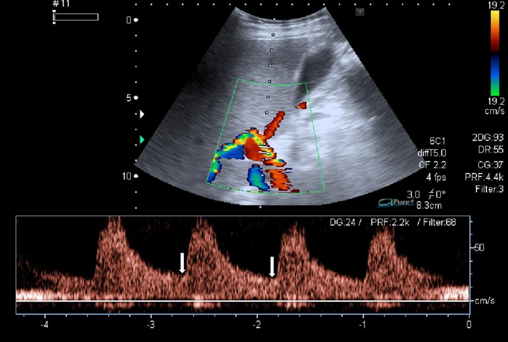 Fig. 2: Hepatic artery: antegrade flow (displayed above the baseline) toward the liver, typical spectral Doppler waveform (pulsatile
