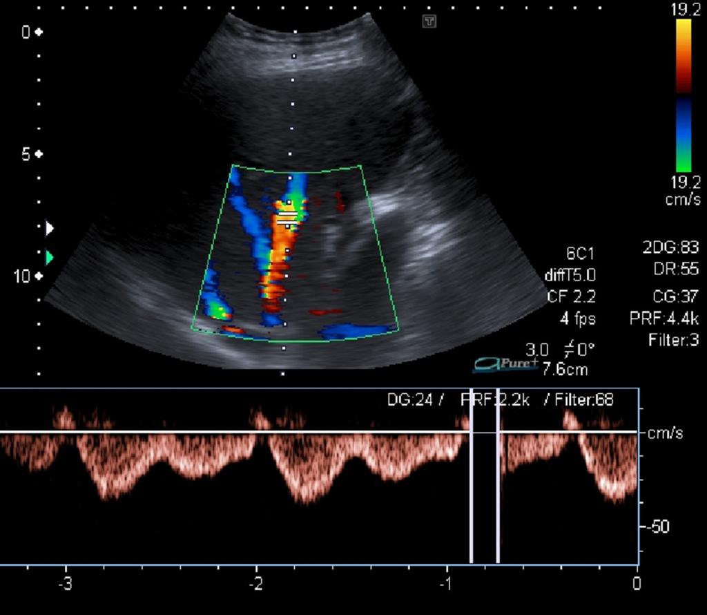 Fig. 4: Hepatic veins: predominantly antegrade flow to the heart, typical spectral Doppler waveform