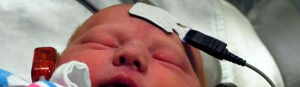 Sensorineural HL in Infancy Prevalence Rate, SNHL Well babies: 1 3:1000 NICU 10