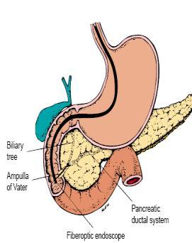 A. Pain and Biliary Colic If a gallstone obstructs the cystic duct, the gallbladder becomes distended, inflamed, and eventually infected (acute cholecystitis).