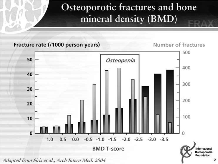 Scientific Article Figure 1. Most Fractures Do Not Occur in Patients with Osteoporosis. Fracture rate (y-axis; wider bars) increases as the T-score moves further below the young adult mean (x-axis).