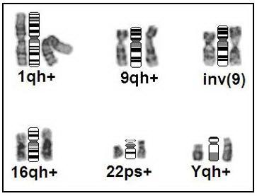 Chromosome heteromorphisms in recurrent abortions 3849 Figure 1. Partial karyotypes showing samples of chromosome heteromorphisms.