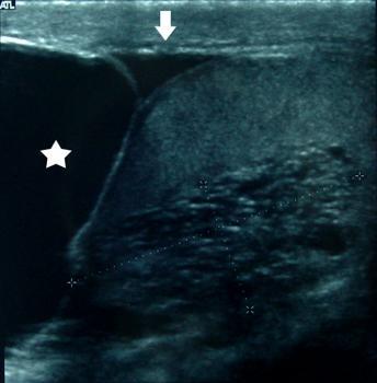 Figures Figure 1 Figure 1a Sagittal sonogram of the right testis depicts an ovoid cluster of small anechoic