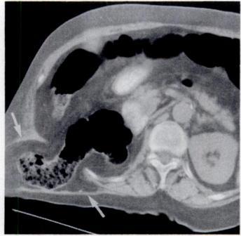 -Hemiation of colon through right pos- Fig. 4.