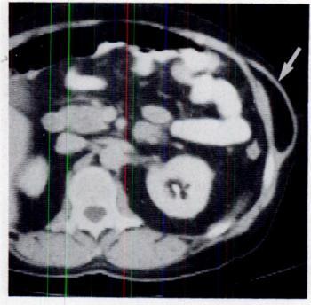 AJR:154, June 1990 CT OF THE ABDOMINAL WALL 1209 Fig. 10.