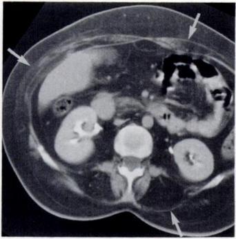 1210 GOODMAN AND RAVAL AJR:154, June 1990 Fig. 16.-Diffuse muscular atrophy with fatty Fig. 17.