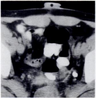 intraabdominal abscess. Usually it involves the subcutaneous tissues or the muscular layer.