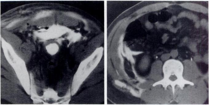 AJR:154, June 1990 CT OF THE ABDOMINAL WALL 1211 Fig. 22.-A and B, Extravasation of contrast material deep and superficial to abdominal wall muscles from extraperltoneal rupture of bladder.