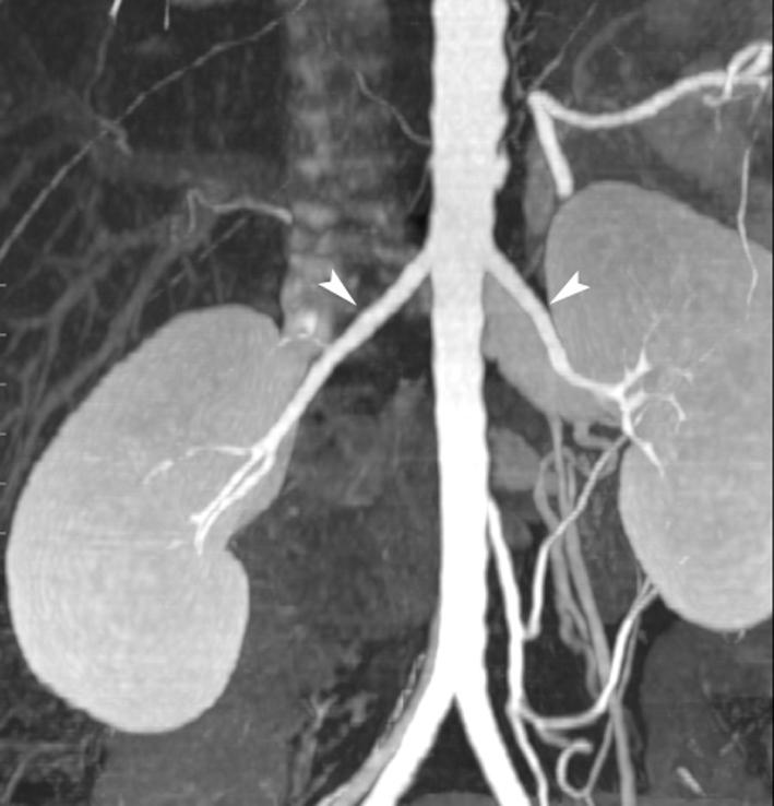 CT Angiography for Living Kidney Donors by the same radiologist.