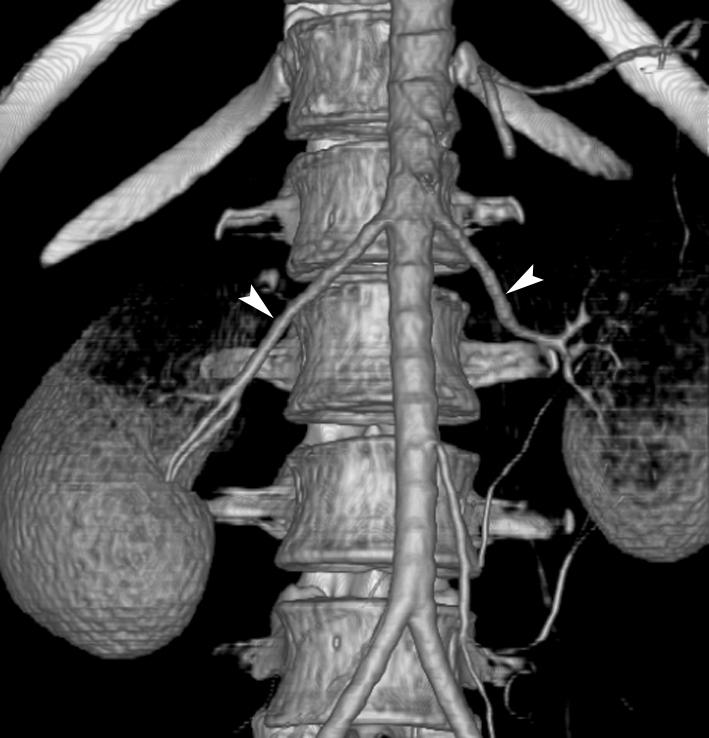 vascular variations in the nondonated side kidneys was evaluated using CT alone.