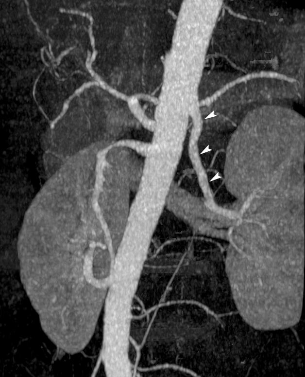 On a second-look of the CT scans (without knowledge of the surgical results), one missed artery and one missed vein on the initial interpretation were detected retrospectively.