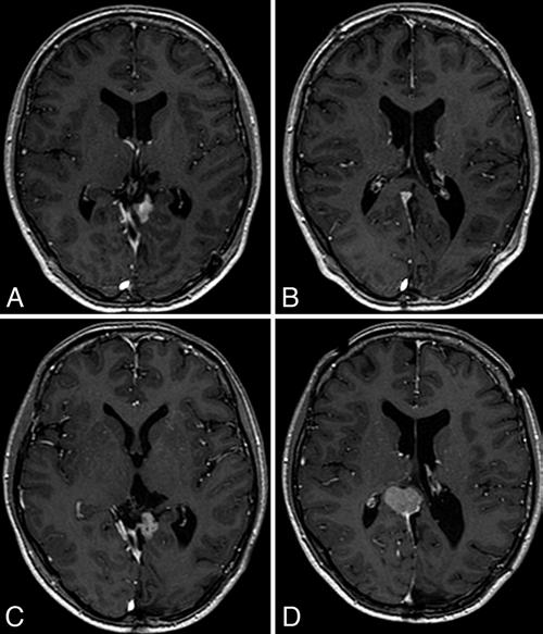 Meningioma and radiosurgery Fig. 1. Kaplan-Meier plot of time to local and regional progression. nual MRI follow-up. A contrast-enhanced TI-weighted sequence was used to measure the tumor size.