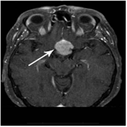 Radiologic brain invasion was noted by the loss of gray matter morphology and distortion as well as the loss of fat plane (arrows) between tumor and normal brain as noted in Figure 2.