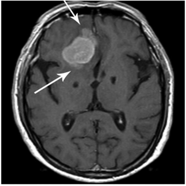 Figure 2: Brain invasion as noted by loss of fat plane (arrows) between tumor and normal brain.