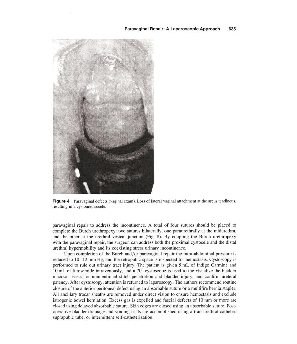 Paravaginal Repair: A Laparoscopic Approach 635 Figure 4 Paravaginal defects (vaginal exam). Loss of lateral vaginal attachment at the arcus tendineus, resulting in a cystourethrocele.