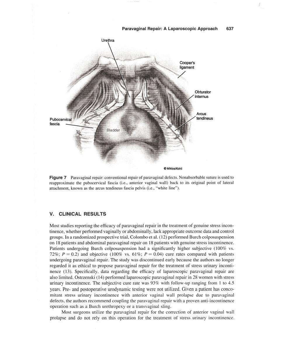 Paravaginal Repair: A Laparoscopic Approach 637 Urethra Arcus tendineus C MlkloslKohli Figure 7 Paravaginal repair: conventional repair of paravaginal defects.