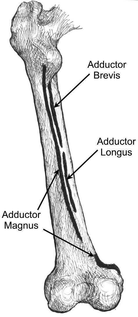 Adductor Insertion Avulsion Syndrome Figure 1. Illustration of the posterior left femur showing insertion sites of the adductor muscles. A Figure 2.