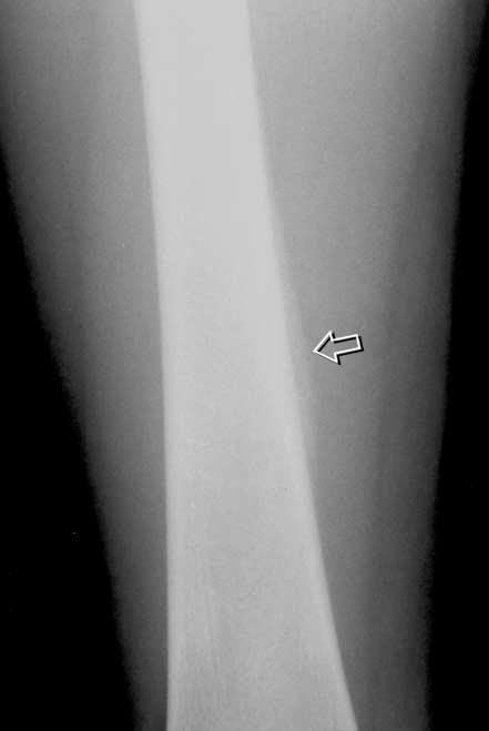 A, Anteroposterior radiograph of the right femur showing a smooth, mature periosteal bone formation (open arrow) of the medial femoral cortex.