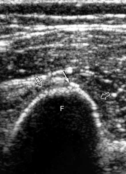 (open arrows). D (opposite page), Axial color Doppler sonogram showing hyperemia (arrow) along the cortex of the femur (F).