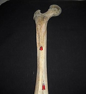 In majority of cases it is located away from the growing end 5. Preservation of vascularisation is important for the healing of the fractured bone and the survival of bone graft.