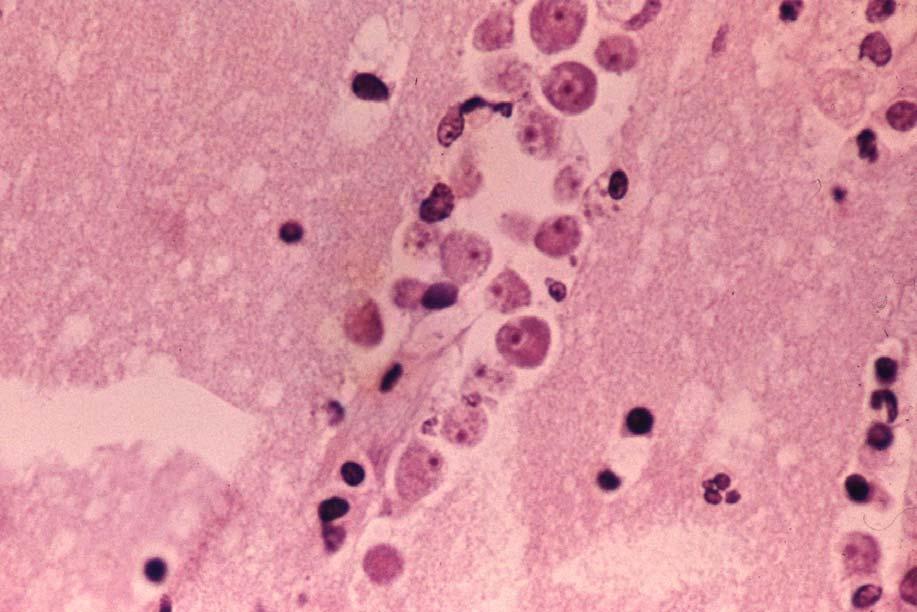 Naegleria fowleri Typical ameboid trophozoites with one