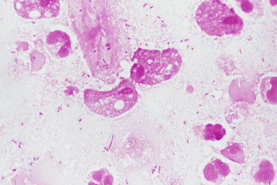 Trichomonas vaginalis Several trophozoites with one nucleus and flagella in a vaginal