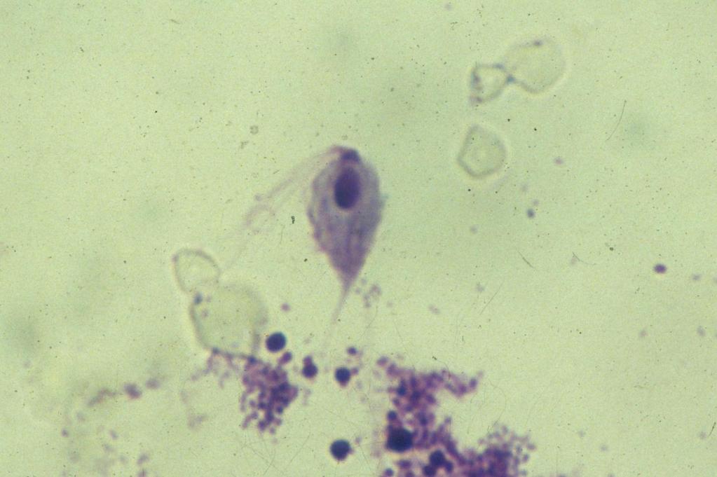 Trichomonas vaginalis In culture diluted with blood.
