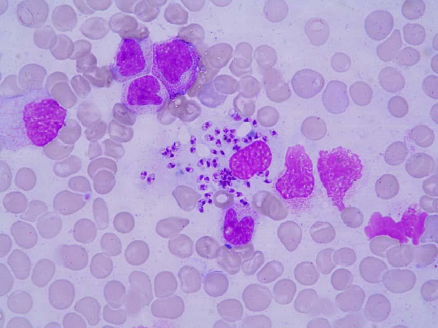 Leishmania sp. Numerous ovoid to round small (2-6 μm) parasites in a bone marrow aspirate.
