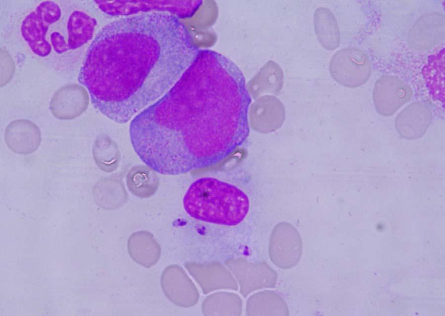 Leishmania sp. Ovoid to round small (2-6 μm) parasites in a bone marrow aspirate.