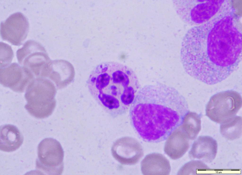 Leishmania sp. Ovoid small (2-6 μm) intracellular parasite in a bone marrow aspirate.