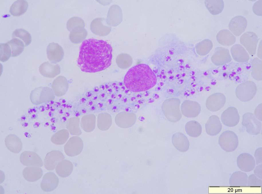 Leishmania infantum Ovoid small (2-6 μm) parasites in a bone marrow aspirate.